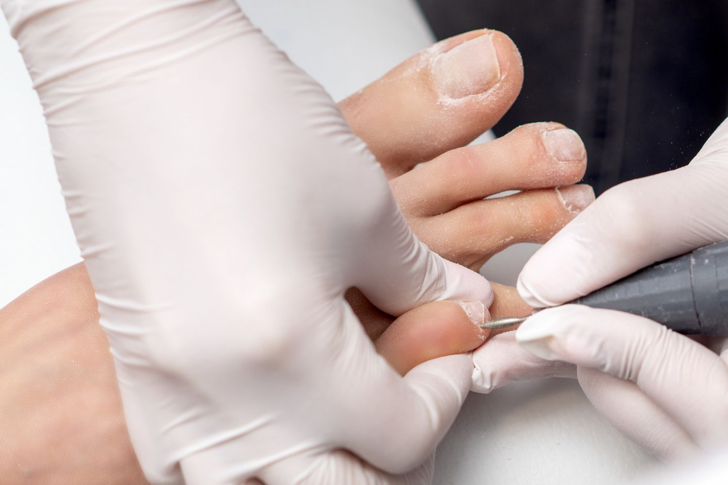 Uñas onicogrifósicas